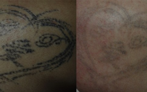 Eliminación de Tatuajes